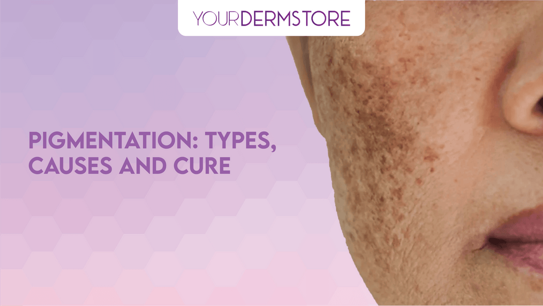PIGMENTATION: TYPES, CAUSES AND CURE