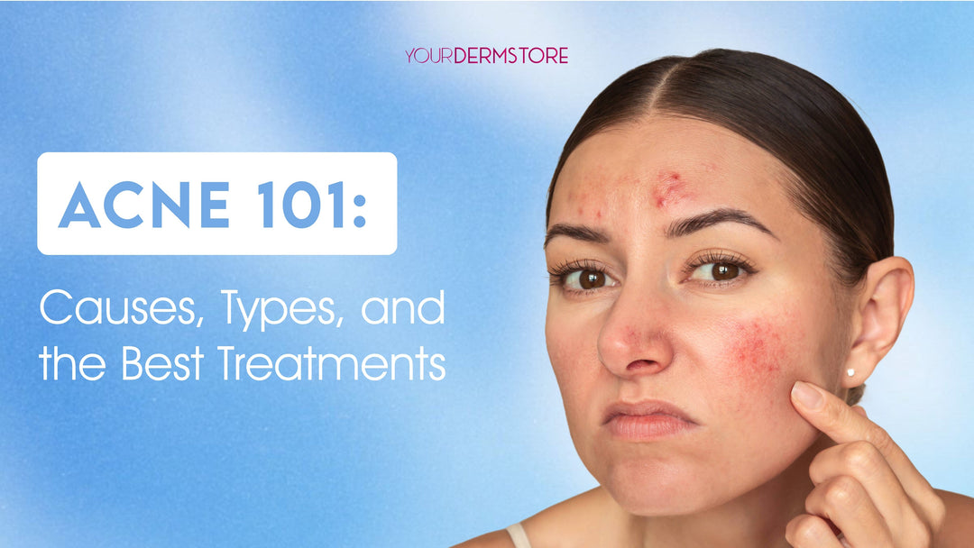 Acne 101: Causes, Types, and the Best Treatments
